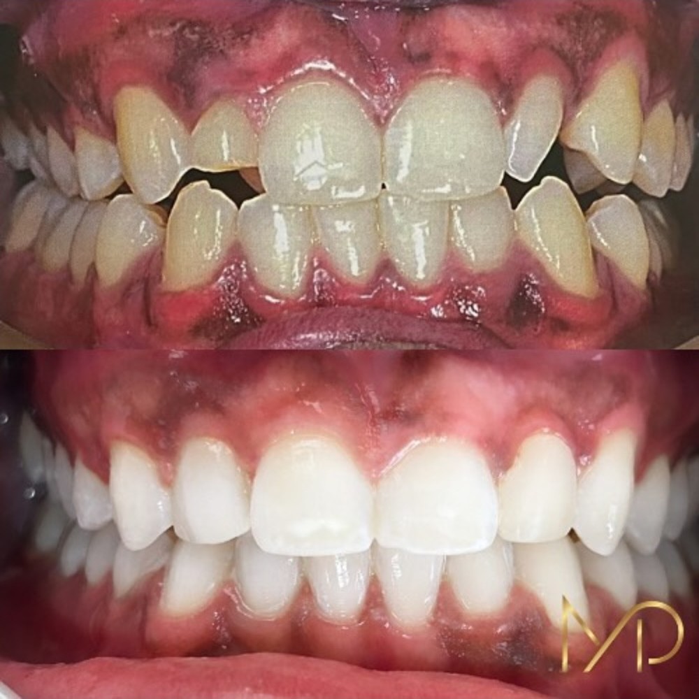 Caso antes e depois